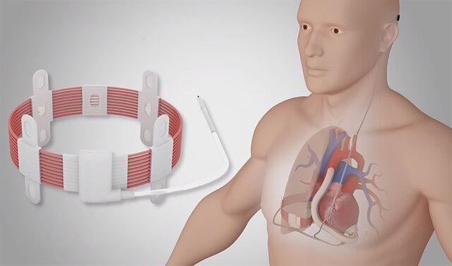 ایمپلنت نخستین پمپ قلب بی سیم دنیا با موفقیت انجام شد