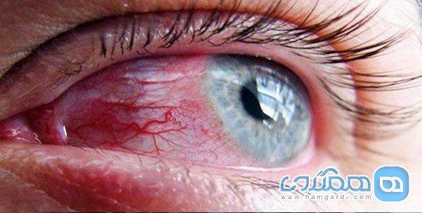 چشم های ناقل کرونا چشم های ناقل کرونا