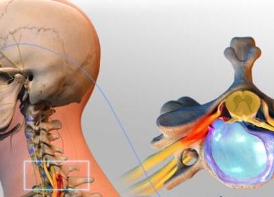 دیسک گردن چیست؟ علائم و روش های درمان کاربردی